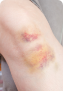 타박상